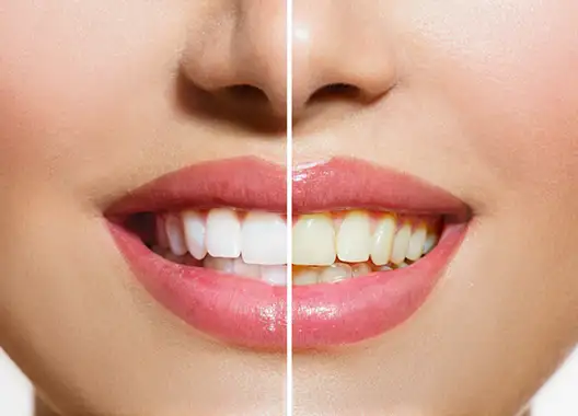 Whitening Treatmet Benefits